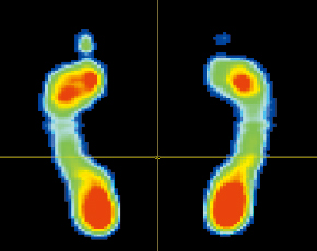 外反母趾の人の足圧