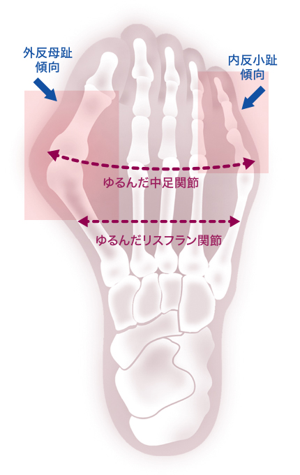 外反母趾・内反母趾